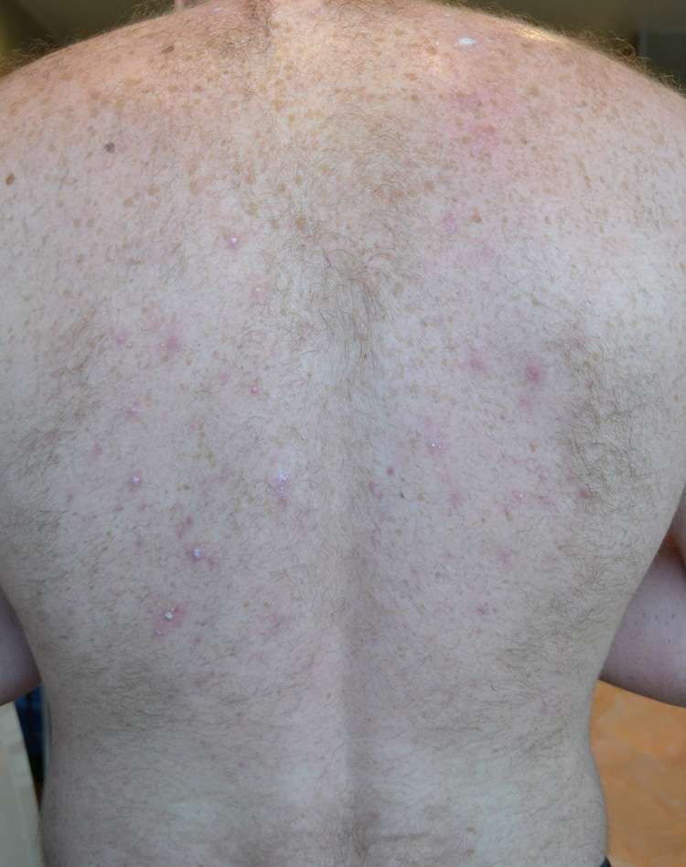 Из-за чего появляются высыпания на спине, как их лечить, советы дерматолога