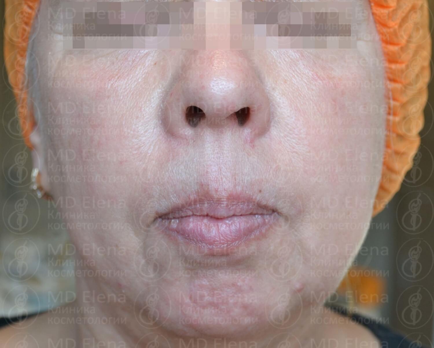 Розацеа на лице лечение фото до и после