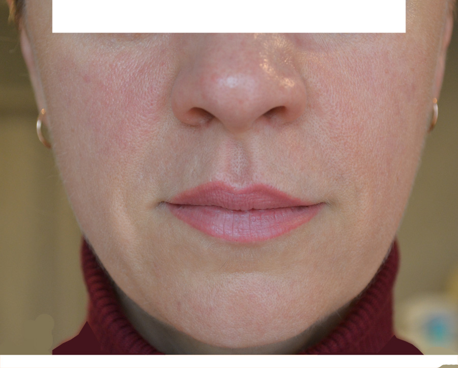 Стероидная розацеа на лице лечение фото до и после процедуры